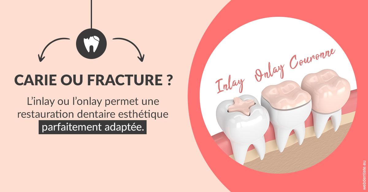 https://dr-ahr-catherine.chirurgiens-dentistes.fr/T2 2023 - Carie ou fracture 2