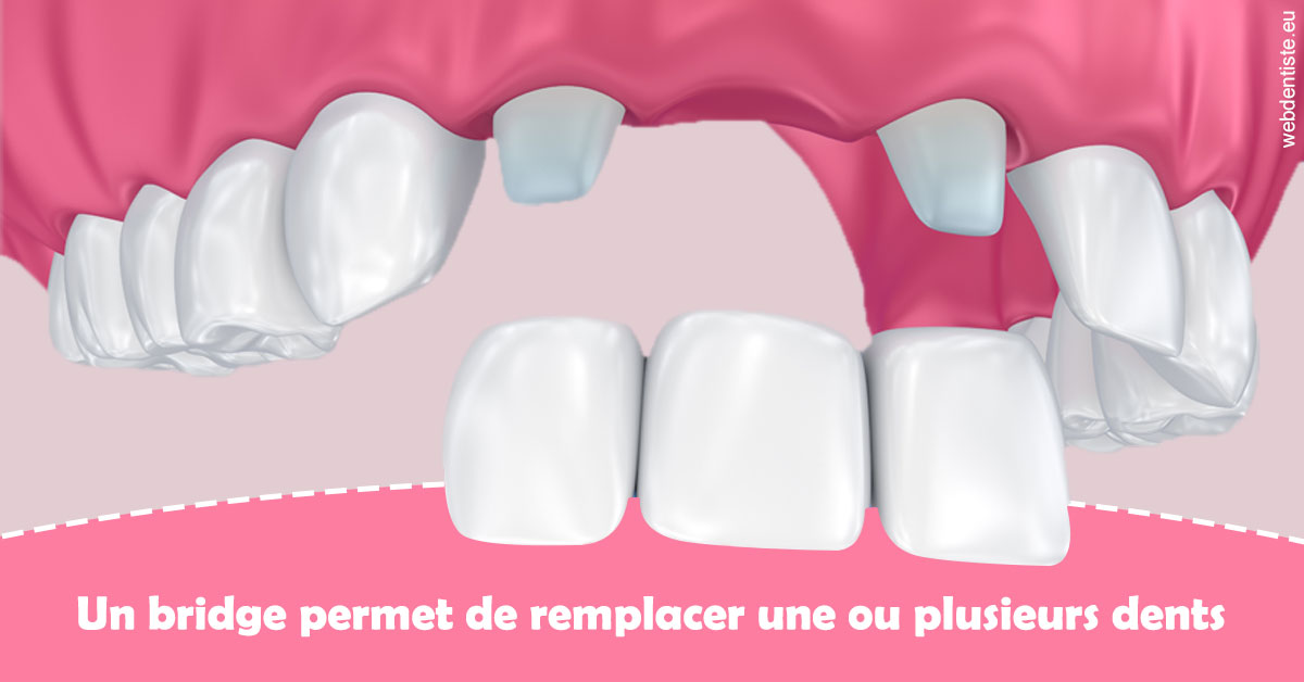 https://dr-ahr-catherine.chirurgiens-dentistes.fr/Bridge remplacer dents 2