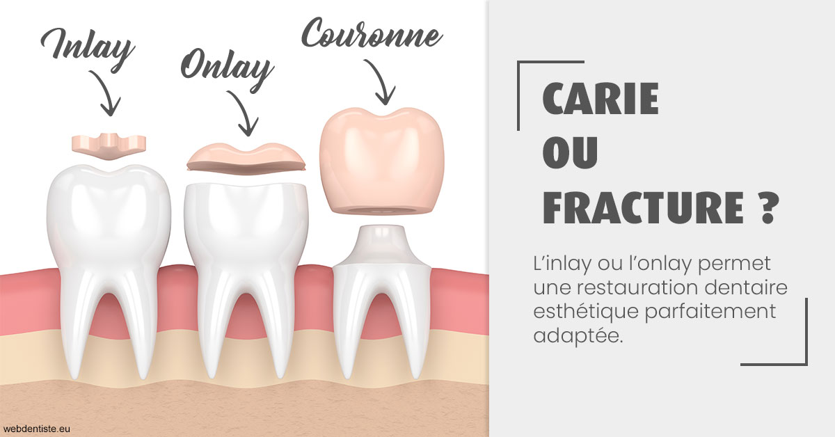 https://dr-ahr-catherine.chirurgiens-dentistes.fr/T2 2023 - Carie ou fracture 1