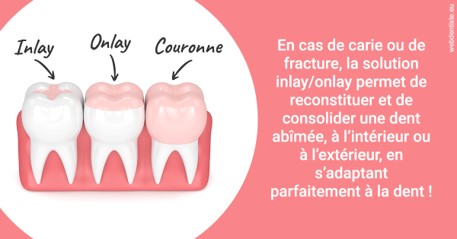 https://dr-ahr-catherine.chirurgiens-dentistes.fr/L'INLAY ou l'ONLAY 2