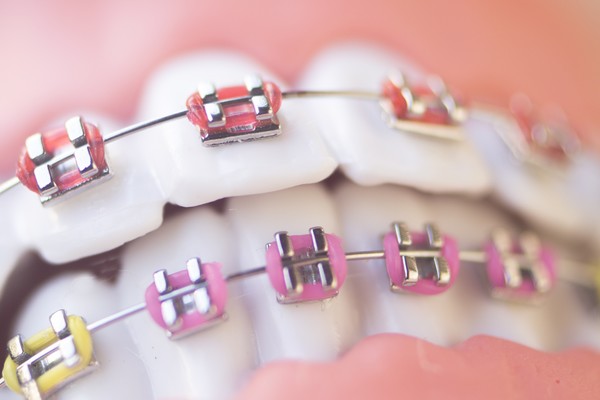 Les élastiques en orthodontie